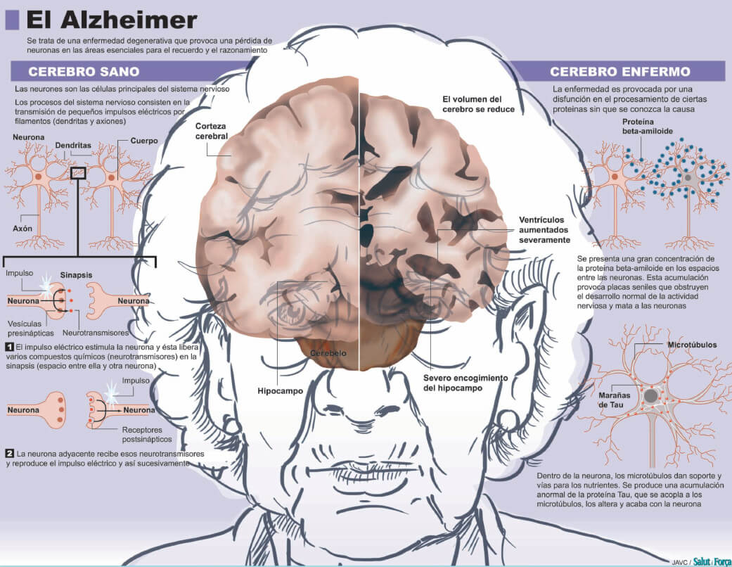 El cerebro y Alzheimer