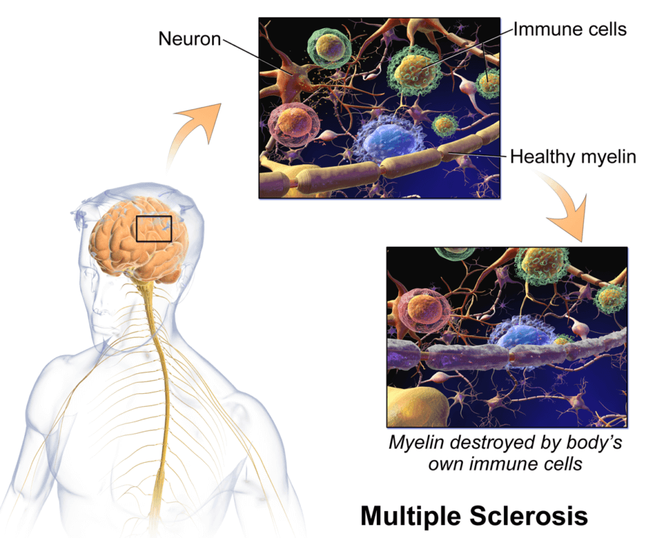 Esclerosis Múltiple - Wikipedia