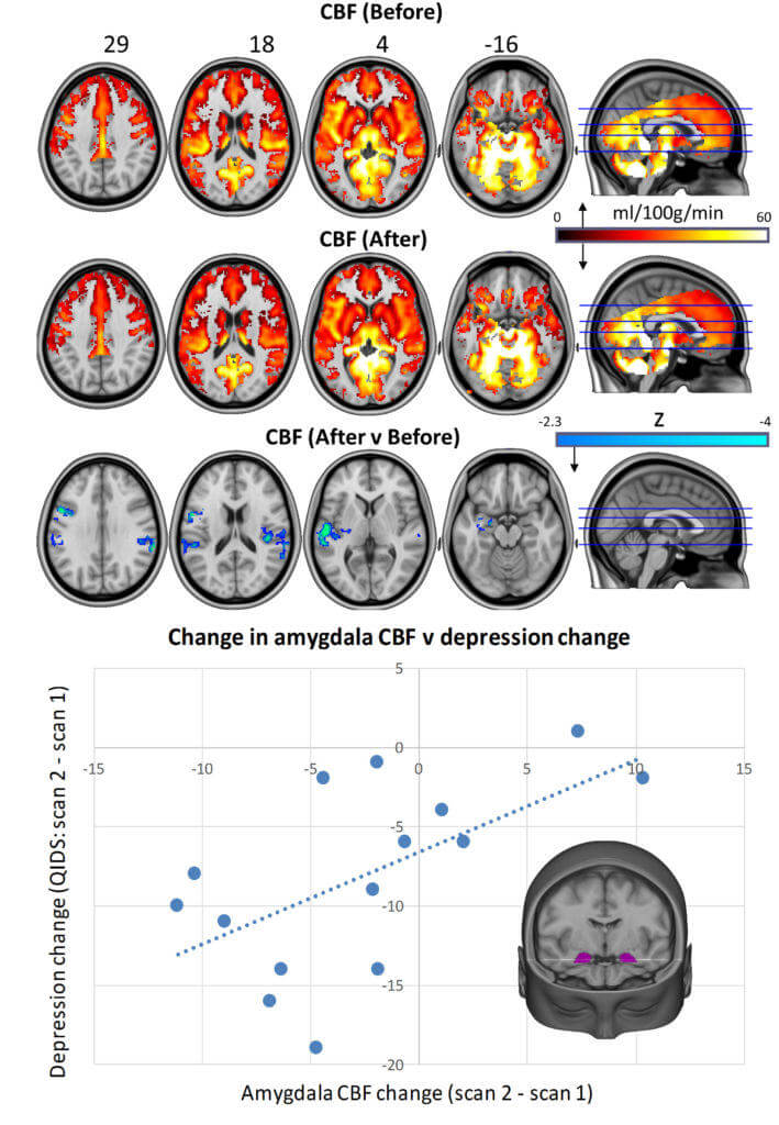 Psilocybin alters brain activity, and is very helpful for treating depression