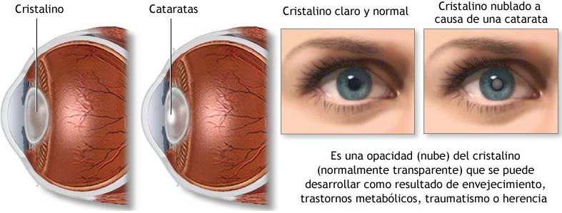 Cataractes