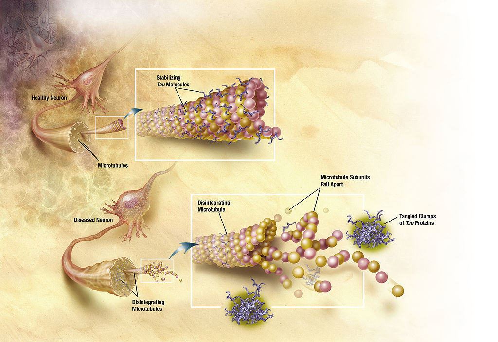 Alzheimer's disease damages brain cells 