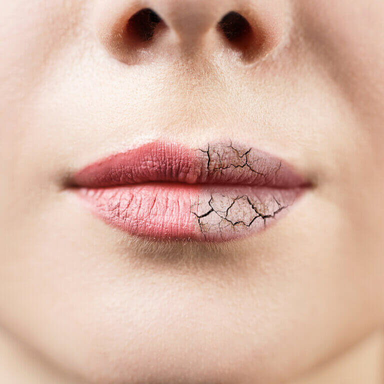 Dry mouth and cannabis use: what it is and how to avoid it