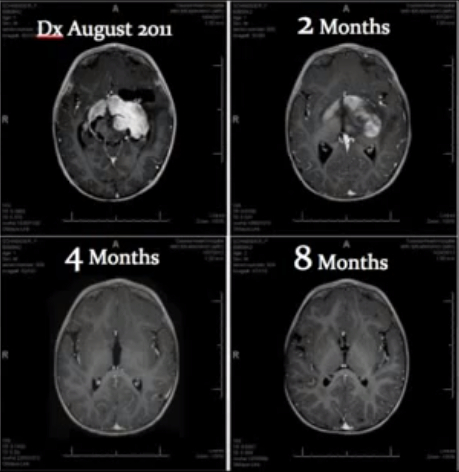 En seulement 4 mois de traitement avec de l'huile de cannabis de Rick Simpson, le Dr William Courtney affirme avoir éliminé l'importante tumeur au cerveau que possédait ce bébé de 8 mois Huile de Rick Simpson et tumeur cérébrale