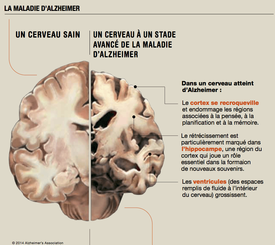 Résultat de recherche d'images pour "alzheimer"