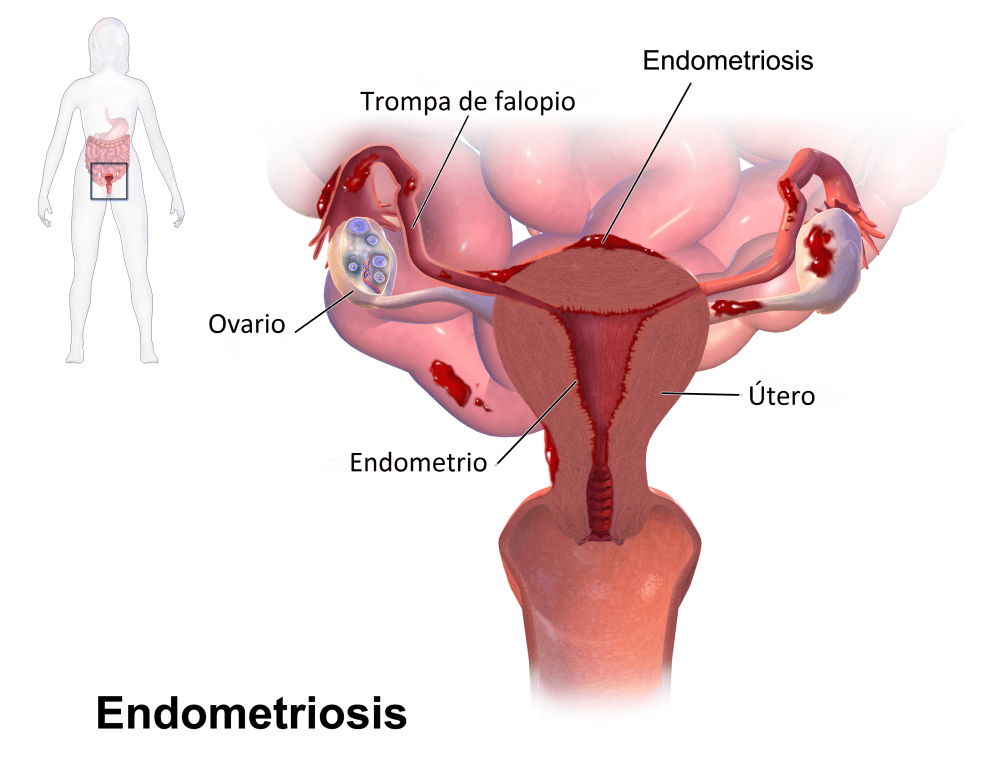 L'Endometriosis